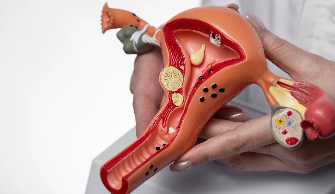 Natural Supplements for PCOS