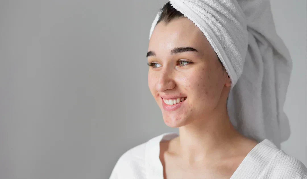 Woman with acne in Pakistan