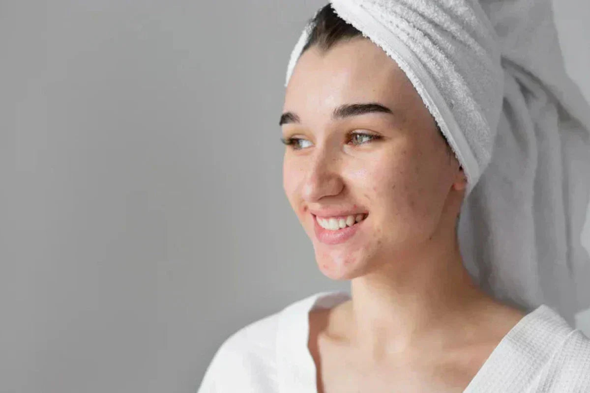 Best Acne Treatment in Pakistan: Effective Solutions for Clear Skin