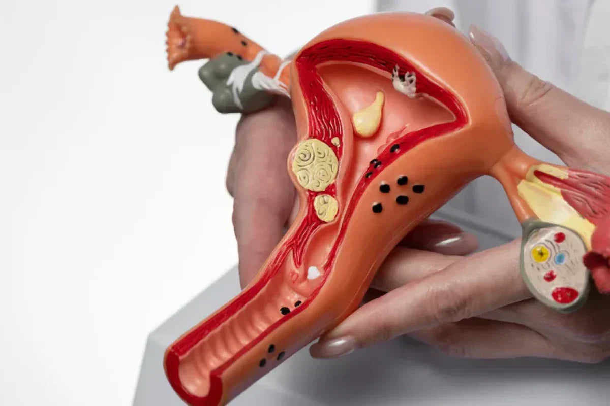 Natural Supplements for PCOS Weight Management and Insulin Resistance